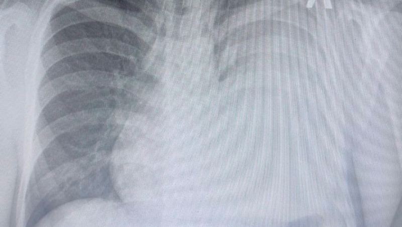 Литр жидкости в лёгком обнаружили у молодого жителя Ставрополья с одышкой