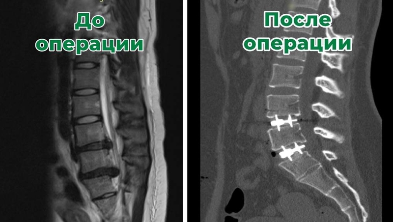 Ставропольские врачи впервые сделали многоуровневое протезирование позвоночника