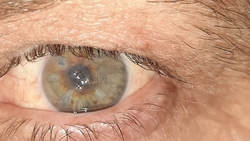 Попавшая в глаз проволока едва не лишила зрения ставропольского газонокосильщика