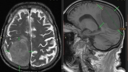 Нейрохирурги Пятигорска удалили у пожилого пациента опухоль размером с лимон 