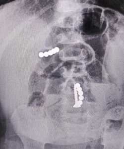 Ставропольские хирурги спасли ребёнка, проглотившего саморез и магниты