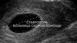 Редкий случай неразвивающейся беременности выявили у ставропольчанки